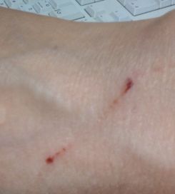 猫が噛んだ傷